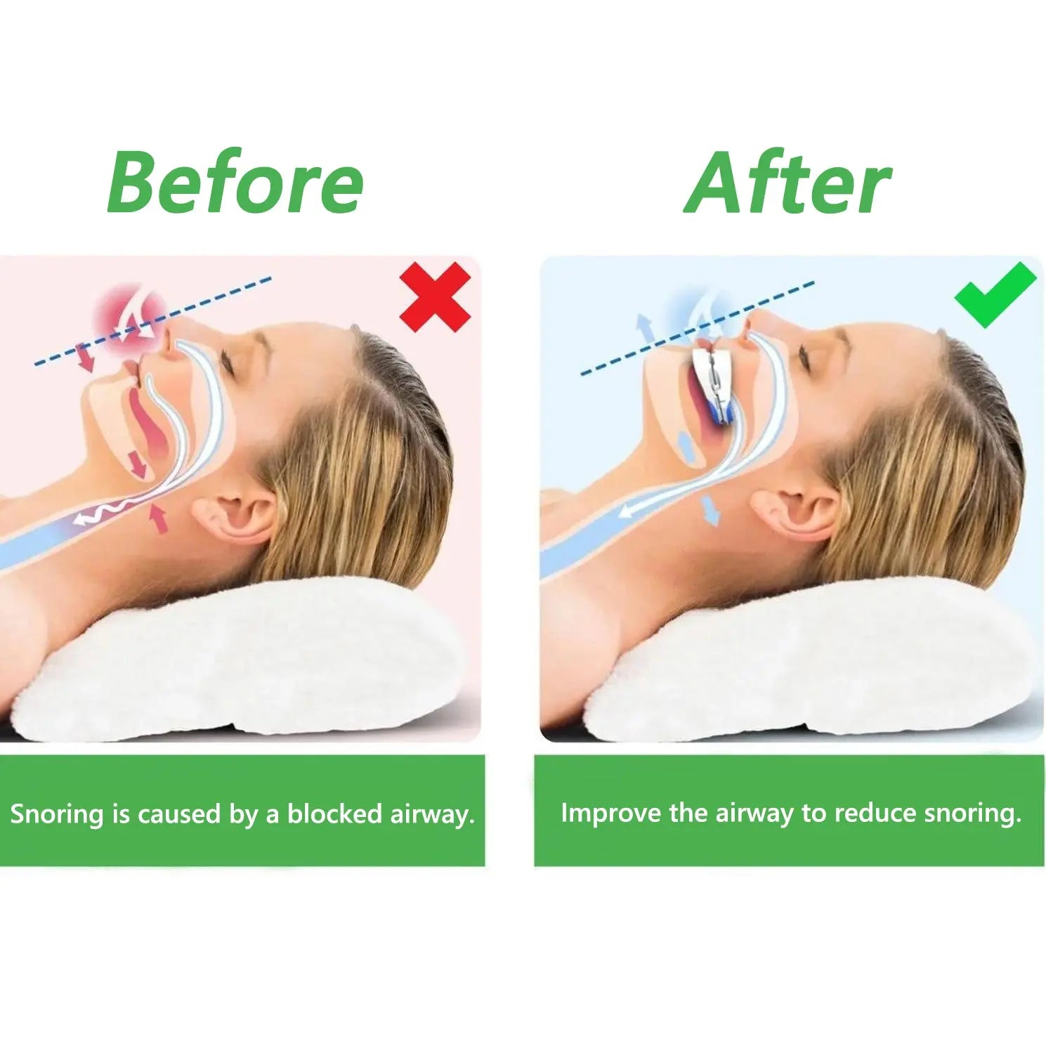VivaCare™ Anti-Snoring Mouthpiece – Full set with device, case and user manual